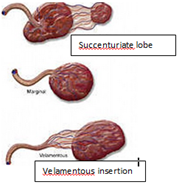 Abnormal attachment of fetal vessels to placenta (overlying cervical os & unprotected from Wharton's jelly) 


 


@ labour -> damage to fetal vessels 


 


Subtypes ; Velamentous (Cord insertion further away from placenta). Succentur...