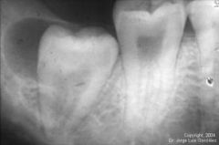 Det är cystor som dyker upp hos partiellt erumperade tänders kronor och rötter. Speciellt tredje molarer.