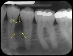 Vad är en lateral periodontalcysta?