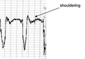 Compression of cord 


 


Associated w/ shouldering 