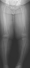Hx:15yo M c/o pain and progressive deformity L knee. xray fig A, w/ the tibial growth plate nearly closed. PE= significant varus and a LLD 2.5cm R >L. Which is the most appropriate method of management at this time?