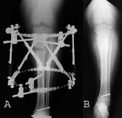 Adolescent Blount's disease with significant varus malalignment, a coexisting leg-length discrepancy, and closed growth plates is best treated=prox tibia osteotomy w/ placement of an ex-fix.