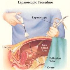 436. Durchführung einer Laparoskopie: 