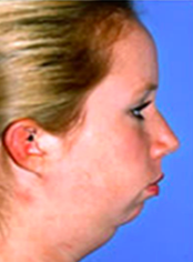 -Convex-Retrusive chin
-Mentalis m strain
-Normal to obtuse naso-labial angle
-ANB > 9
-Dental compensation