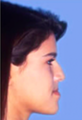 -Concave 
-Hypoplastic midface
-Prognathic md
-Combo
-Retrusive upper lip
-ANB > -1
-Dental compensation
