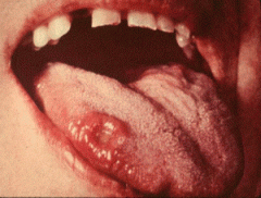 chancre - painless round ulcer at point of infection
Resolves 2-3 months
Regional lymphadenopathy