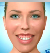 -Incr/steep FMPA
-Incr LAFH
-Vert Mx excess
-Long face syndrome
-Excessive gingival display
-Normal upper lip length