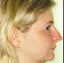 -Short face syndrome
-Edentulous appearance
-Reduced LAFH
-Deep LM fold
-Reduced/flat FMPA (can only open a bit by ortho)