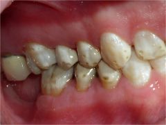 o	21 y.o. Caucasian female
o	Presents to general dentist for routine care
o	No health problems per patient
•	Description:
o	Generalized white and brown discoloration of enamel surfaces with enamel pitting.