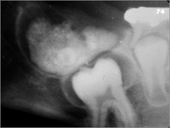 o	8 year old male
o	This boy’s mother brought him to the family dentist for evaluation of the reason for lack of eruption of his right mandibular first molar. 
o	The alveolar bone was slightly expanded and the surface mucosa was unremarkable
...
