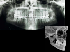 o	18-year-old Caucasian female who previously underwent surgical removal of teeth #1, #16, #17, and #32.  The patient presents today for a routine exam
o	Patient would like to have her teeth whitened