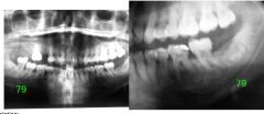 55 year AA Female
Presented for routine dental evaluation
Asymptomatic
Pt. has HTN controlled with Lopressor
Family history of cancer
	
Multiple, small, irregular shape, well defined, non corticated radiopacities surrounded by radiolucent ri...