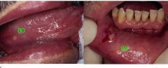o	A 45-year-old male developed a sore mouth after eating fish. His oral pain has been continuous for 2 months. He had no history of eye, genital, or skin lesion. He had no systemic problems. He was given symptomatic treatment and was asked to retu...