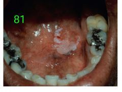 o	During routine exam of a 34-year-old male, a lesion was discovered in the floor of his mouth. He was unaware of the lesion. He did not smoke and was a “light drinker.” He had no history of an associated traumatic event or habit that might re...