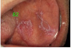 o	55 year old female 
o	Health history positive for menopause
o	Patient has a 30 pack year history
o	She noticed this area on her cheek 1 month ago
o	Exam shows a similar lesion on the other side and on her tongue
•	Description:
o	Two, lar...