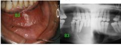 o	A 29-year-old male presented because of a slowly enlarging anterior mandible. The swelling was noted several weeks after an auto accident. He had no symptoms.
o	One large well defined, corticated multilocular radiolucent lesion associated with ...