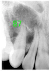 o	This 23 yo female presented with a swelling of the right maxilla for 2 weeks.
•	Description:
o	One large irregular shaped radiolucent multilocular lesion located around the root of tooth #6 displacing teeth #7 and #5