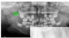 o	5 year old female. This girl has had “loose teeth” for several years, starting with her primary dentition. She has 2 brothers with the same problem and one sister without the problem. Her mother had all of her teeth extracted when she was 19...