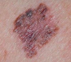 - Raised borders
- Brown lesions with pinks, whites, grays, or blues
- More common in elderly