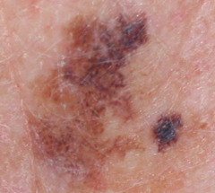 - Most often in elderly (commonly in 7th decade of life)
- Usually on chronic, sun-damaged skin such as the face, ears, arms, and upper trunk
- Tan to brown lesions with very irregular borders