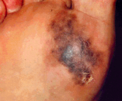 - Begins in situ
- Usually found under the nails, on the soles of the feet, and on the palms of the hands
- Flat, irregular, dark brown to black lesions