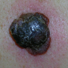 - Brown to black lesions that arise from nevi or normal skin
- Typically is invasive at the time of diagnosis