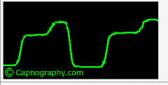 8. The following capnography trace was observed in an intubated and ventilated patient. The most likely explanation for this respiratory pattern is


A. endobronchial intubation


B. endotracheal cuff leak


C. gas sampling line leak


D. ...