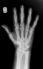 Radiopaque structures obstruct the passage of x-rays (appear white on x-ray film)