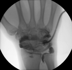 X-ray recording of a joint after injecting a contrast medium into the joint