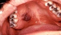 Vascular tumour with different clinical manifestations
Dusky coloured areas on oral mucosa and skin
AIDS associated