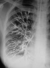 X-ray recording of the bronchial tree and lungs after instillation of a contrast medium into the bronchi via the trachea