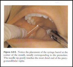 -27 or 25-gauge long needle (yellow)
-target: mucous membrane on medial side of ramus -> aim where IAN start to enter into mandibular foramen (area just above entrance)
-needle insertion: 3/4 up anterior-posterior, most distal end of the pterygoma...