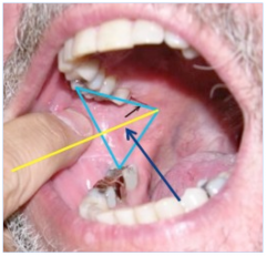 -place middle finger below the ear canal
-place thumb on anterior border of ascending ramus (maximum patient opening, retract cheek slightly)
-Triangle: base = thumb on anterior border of ramus, upper side = posterior maxilla, lower side = pterygo...