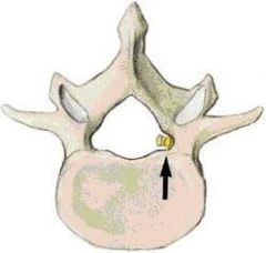 In onderstaande afbeelding wordt met een pijl een belangrijke structuur weergegeven die zich in het foramen vertebrale bevindt.


Wat is deze structuur?