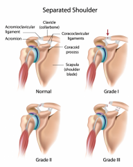 during SHOULDER SEPARATION which leads to injury to ligaments of AC joint and unstable AC joint causing pain and dysfuncition of shoulder joint