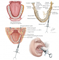 -only use when molar buccal mucosa is involved -> extraction, SRP, deep seated rubber dam clamp, removal of subgingival caries, placement of gingival retraction cord
-target: buccal nerve as it passes over the anterior border of ramus
-insertion: ...