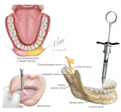 -terminal branch of IAN and provides sensory to boucle soft tissue anterior to mental foramen and soft tissue of lower lip and chin (only soft tissue -> NO pupal)
-27 or 25 gauge short needle
-target: mental nerve as it exits the mental foramen
-i...
