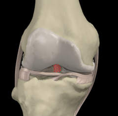 Prevents anterior displacement of the tibia, also stabilizes against abnormal internal & external rotation