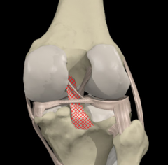 prevents posterior displacement of the tibia, primary stabilizer of the knee.
