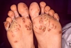 Arthritis, urethritis, conjunctivitis
 
circinate balanitis- serpiginous dermatitis of penis
 
keratoderma blenorrhagicum- foot