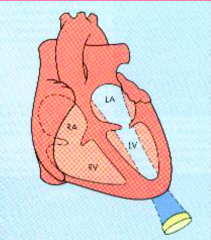 heart valve regurtitation
