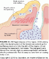 Celulas grandes localizadas en epidermis y que tienen halo claro.