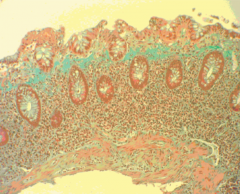 - segmentale Verdickung des subepithelialen Kollagenbandes (verminderter Kollagenabbau)


- lymphoplasmazelluläre Infiltration der Lamina propria (Bild)