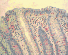 - intraepitheliale Lymphozytose in der Dickdarmschleimhaut


- Abgeflachtes Epithel (Bild)