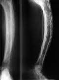 weakened and irregular cancellous bone overgrowth in the femur