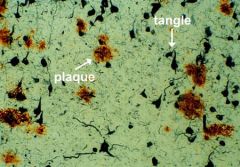 1. Quantity of senile plaques (age-specific) - focal collections of dilated, tortuous neuritic processes surrounding central amyloid core (amyloid beta-protein)
2. quantity of neurofibrillary tangles- bundles of neurofilaments in cytoplasm of neu...