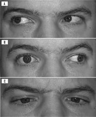 strongly suggests the diagnosis of MS - ipsilateral medial rectus palsy on attempted lateral gaze and horizontal nystagmus of the abducting eye (contralateral to the side of the lesion) this is due to a lesion of the medial longitudinal fasiculus
...