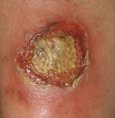 seen in infection with pseudomonas aeroginosa 

rapidly progressing, necrotic cutaneus lesion caused by pseudomonas bacteremia

typically seen in immunocompromised patients