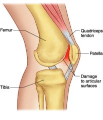 Damage to the underside of the patella due to cumulative trauma from repetitive stress or damage caused by abnormal alignment of the tibia and femur
