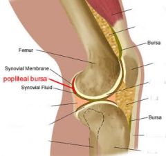 between the popliteus tendon and the lateral tibial condyle